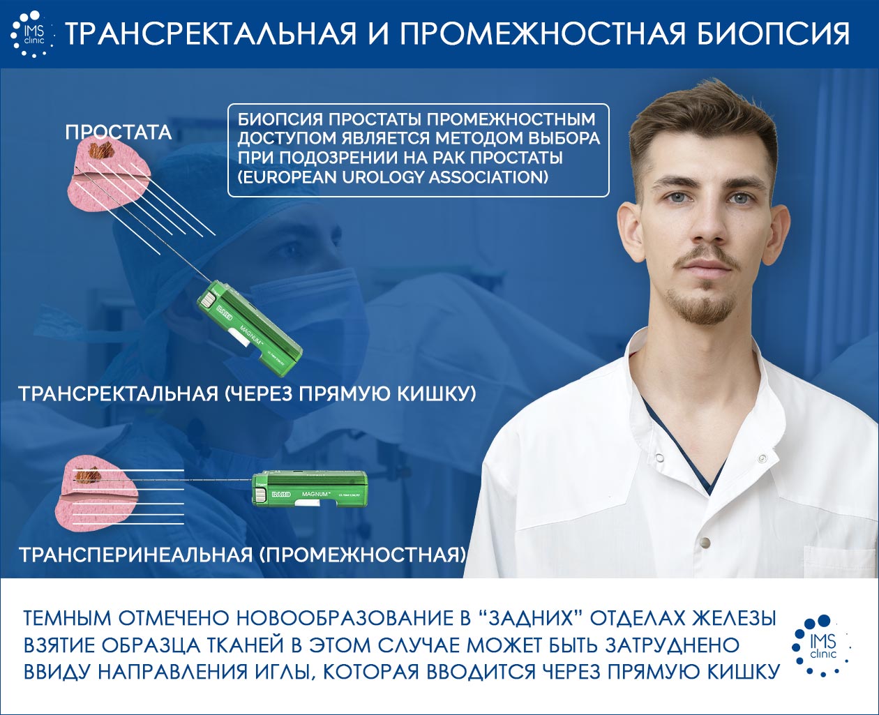 Биопсия предстательной железы в СПб, цена на биопсию простаты