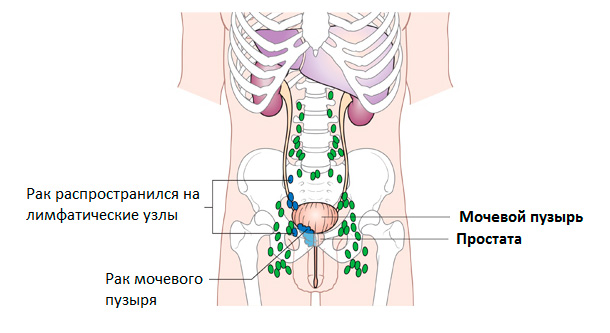 Выпадение прямой кишки (ректальный пролапс)