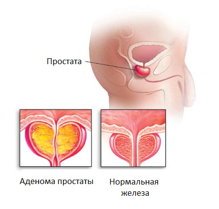 Аденома предстательной железы: лечение