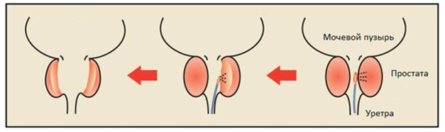 После удаления аденомы простаты
