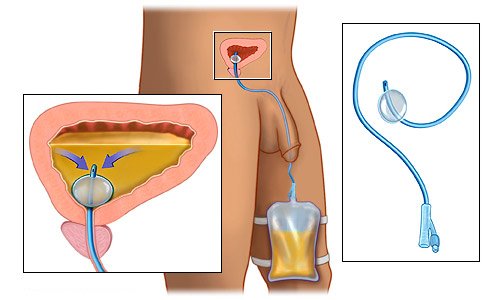 Prostatitis és katéter Trilon- b prostatitis