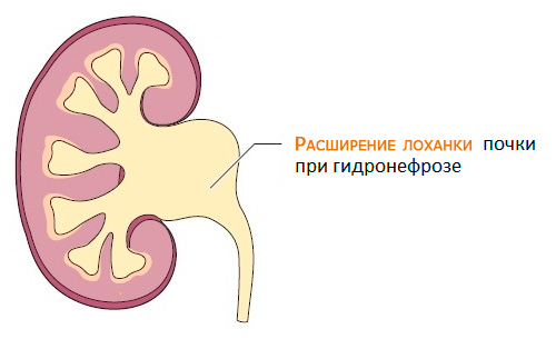 Гидронефроз у детей презентация