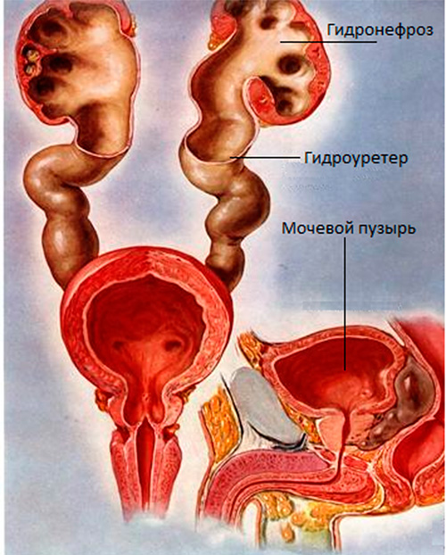 Пиелонефрит (Pyelonephritis)