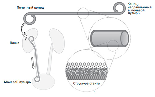 Стенд из почки в мочевой пузырь фото