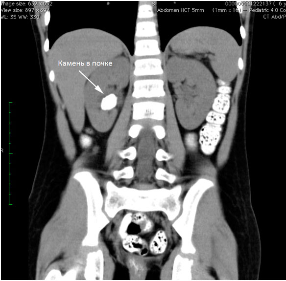 Где сделать компьютерную томографию почек