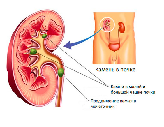 камни в почках как вывести народными средствами | Дзен