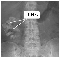 На представленной рентгенограмме визуализируются камни почки