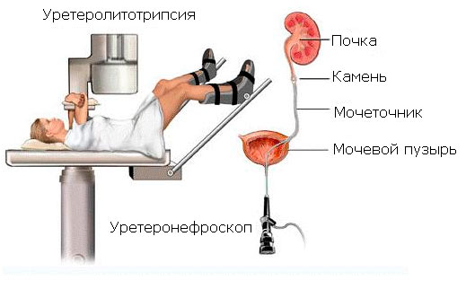 Камни в почках - симптомы, причины и лечение у женщин и мужчин