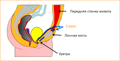 Недержание мочи операция сетка