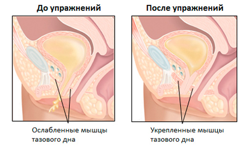 Упражнения Кегеля. Что это и зачем они нужны. Советы хирурга-гинеколога Слободянюка Б. А.