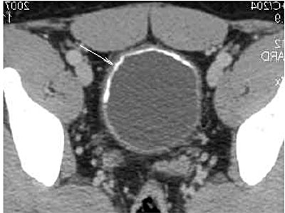 Компьютерная томография, отражающая кальцификацию и утолщение стенки мочевого пузыря