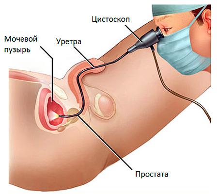 Задержка мочеиспускания