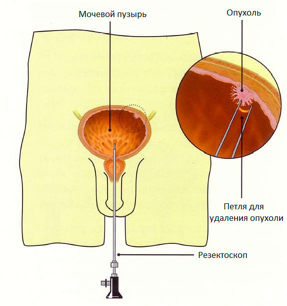 Операция на мочевом пузыре у мужчин. Тур резекция мочевого пузыря. Трансуретральная резекция лейкоплакии мочевого пузыря. Трансуретральная резекция простаты (Турп). Трансуретральная резекция мочевого пузыря у мужчин.