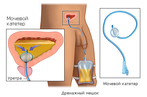 Prostatit katéter