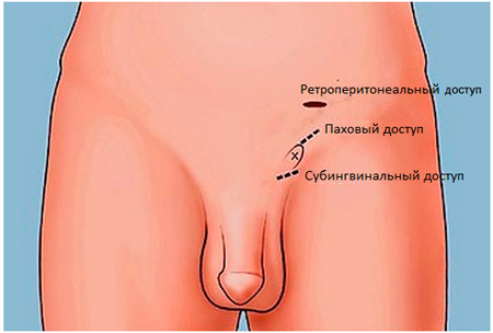 Лечение варикоцеле: операции Мармара и Иваниссевича