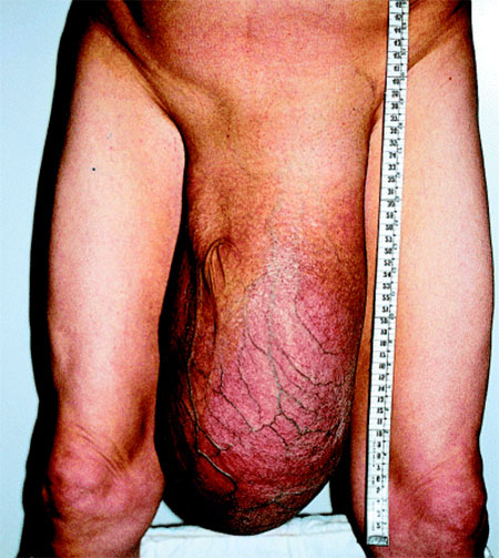 Гидроцеле (водянка яичка) — болезнь яичек у мужчин