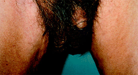 Гидроцеле (водянка яичка) — болезнь яичек у мужчин